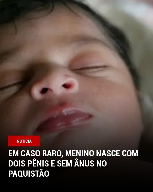 Em caso raro, menino nasce com dois pênis e sem ânus no Paquistão