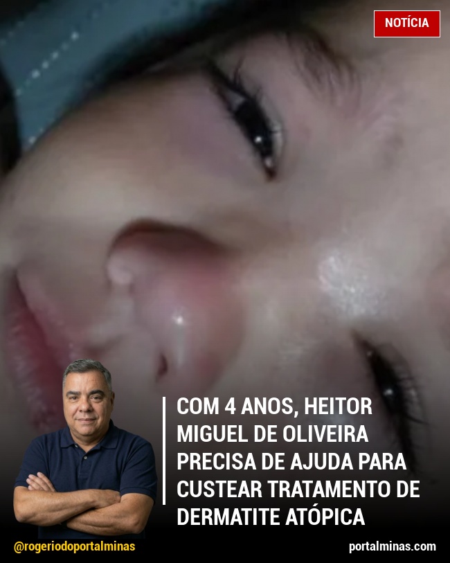 Com 4 anos, Heitor Miguel de Oliveira precisa de ajuda para custear tratamento de dermatite atópica severa
