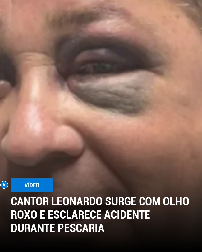 Cantor Leonardo Surge com Olho Roxo e Esclarece Acidente Durante Pescaria
