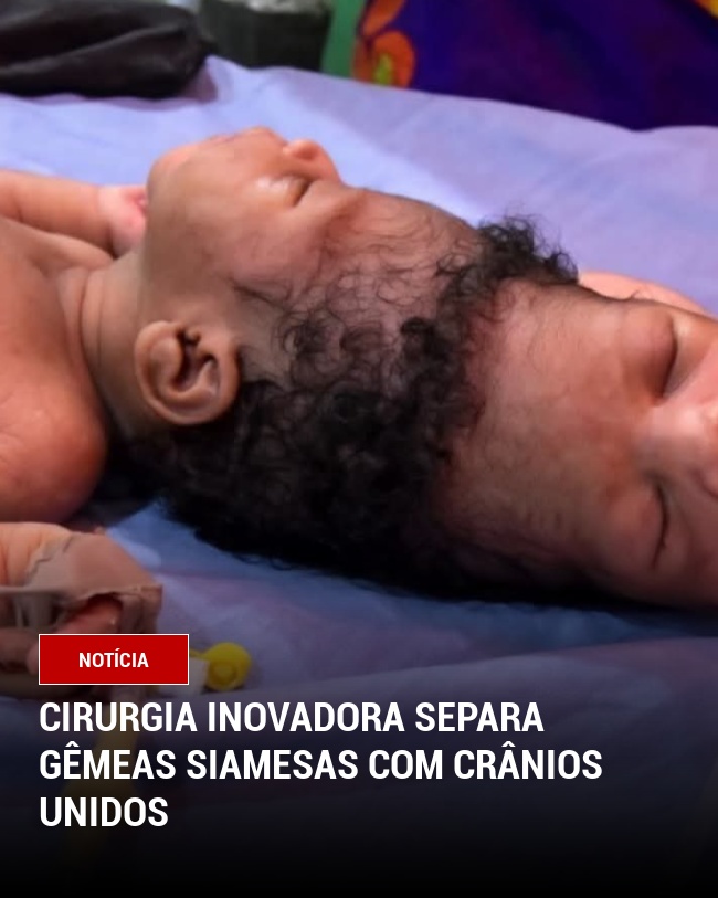 Cirurgia Inovadora Separa Gêmeas Siamesas com Crânios Unidos
