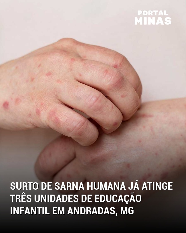 Surto de Sarna Humana já Atinge Três Unidades de Educação Infantil em Andradas, MG