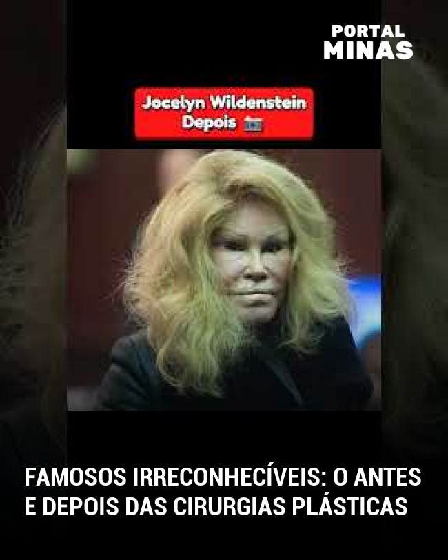 Famosos irreconhecíveis: o antes e depois das cirurgias plásticas