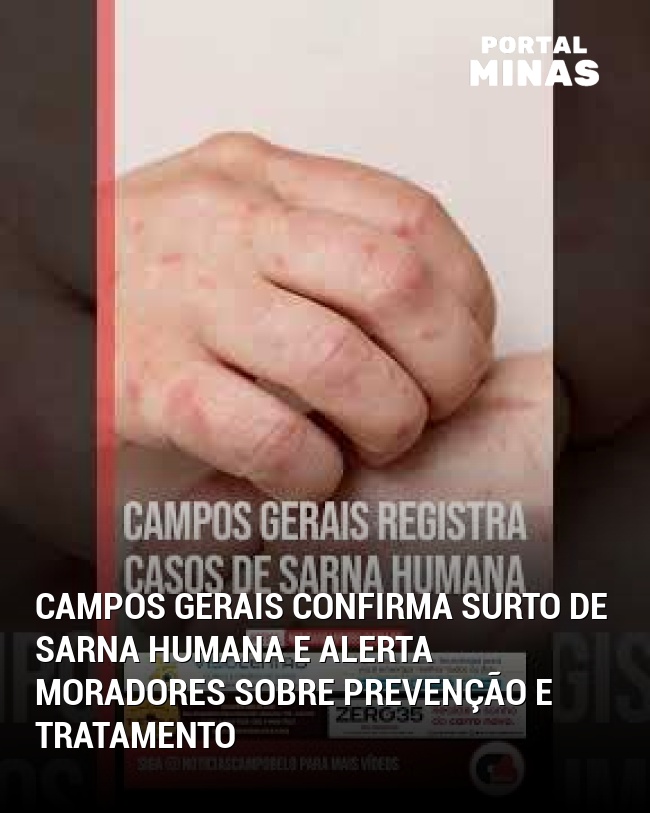 Campos Gerais confirma surto de sarna humana e alerta moradores sobre prevenção e tratamento