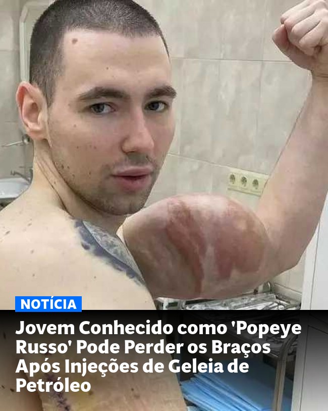 Jovem Conhecido como 'Popeye Russo' Pode Perder os Braços Após Injeções de Geleia de Petróleo - Post para compartilhamento via WhatsApp