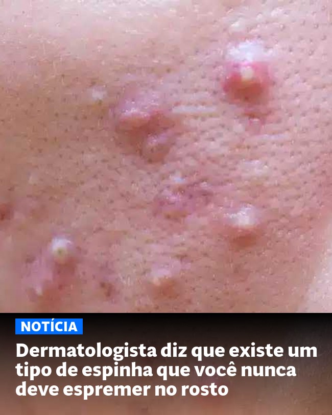 Dermatologista diz que existe um tipo de espinha que você nunca deve espremer no rosto - Post para compartilhamento via WhatsApp