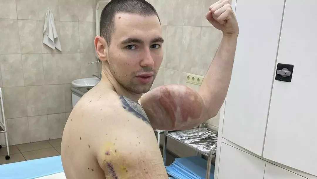 Jovem Conhecido como 'Popeye Russo' Pode Perder os Braços Após Injeções de Geleia de Petróleo