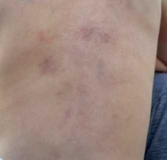 Mãe acusa Apae de agressão a filha autista de 5 anos em Ituiutaba