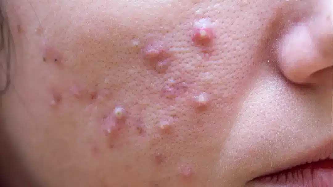 Dermatologista diz que existe um tipo de espinha que você nunca deve espremer no rosto