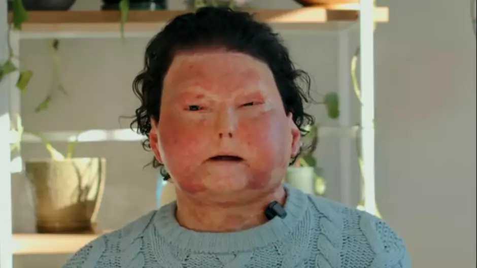 Homem que realizou primeiro transplante bem-sucedido de rosto e mãos revela detalhes inéditos em livro