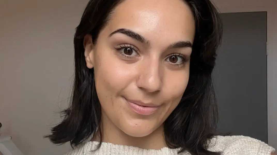 A vida de Sumbul Ari, uma jovem de 26 anos, tomou um rumo inesperado e desafiador em abril de 2025. Foi nesse período que uma coceira persistente e inte...
