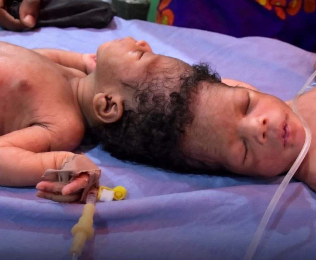Mercy e Goodness, irmãs siamesas originárias da Nigéria que nasceram com os crânios unidos, passaram por uma bem-sucedida cirurgia de separação nos Emir...