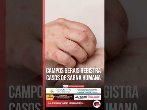 Campos Gerais, no Sul de Minas, enfrenta uma preocupante elevação nos registros de sarna humana, também conhecida como escabiose. As autoridades de saúd...